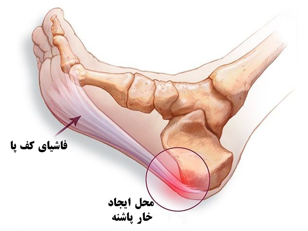 خار پاشنه یا التهاب پرده کف پا چیست؟
